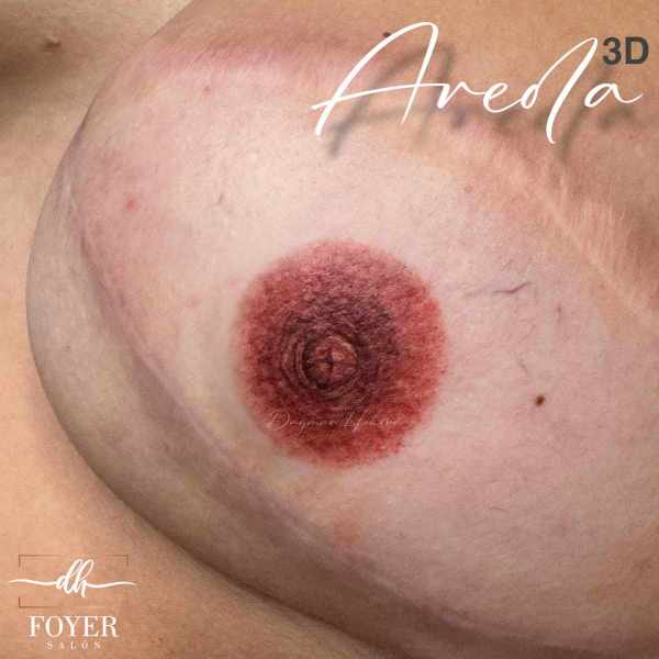 3D Areola onko