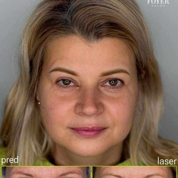 oprava - laser - powder brows permanentný makeup